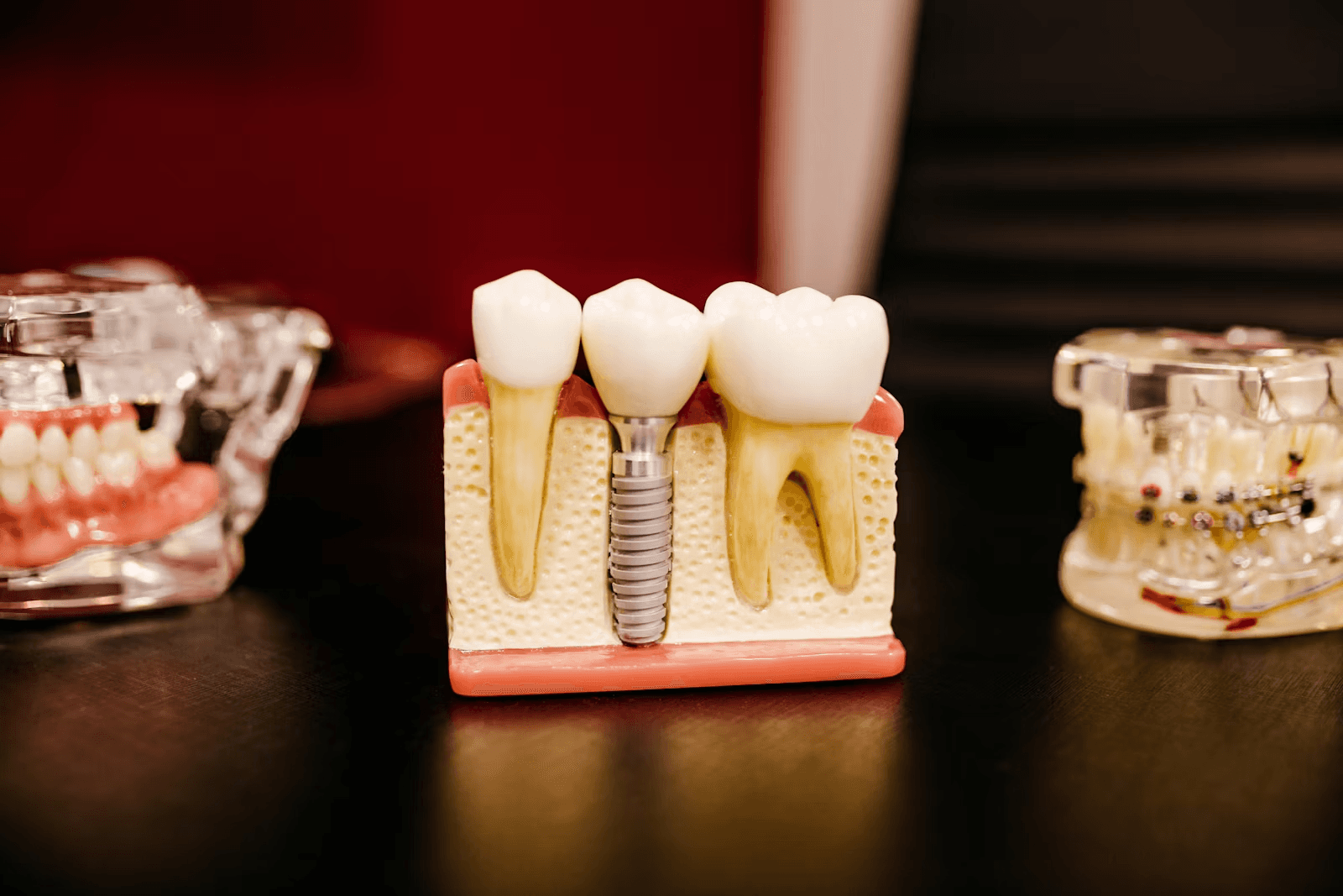 Dental implant and crown models made in the in-house dental lab