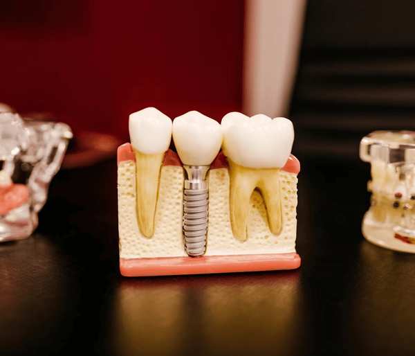 Dental implant and crown models made in the in-house dental lab