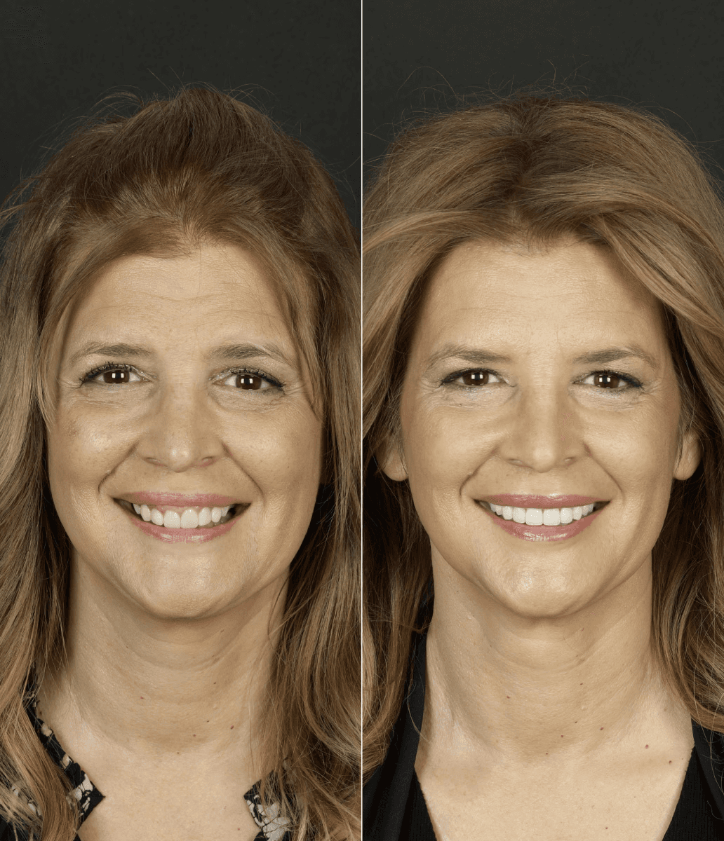 Before and after smile makeover at Bensonhurst Dental in Brooklyn: woman with worn teeth given a brighter, more even smile