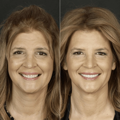 Before and after smile makeover at Bensonhurst Dental in Brooklyn: woman with worn teeth given a brighter, more even smile