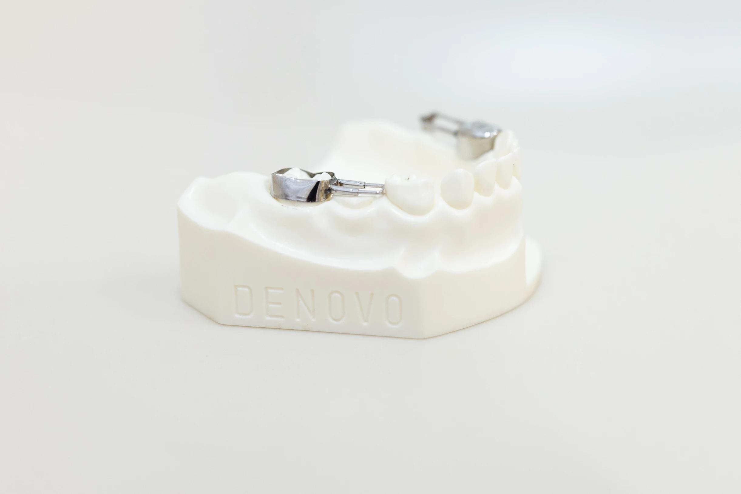 Get Custom Dental Spacers for Children in Palo Alto, CA