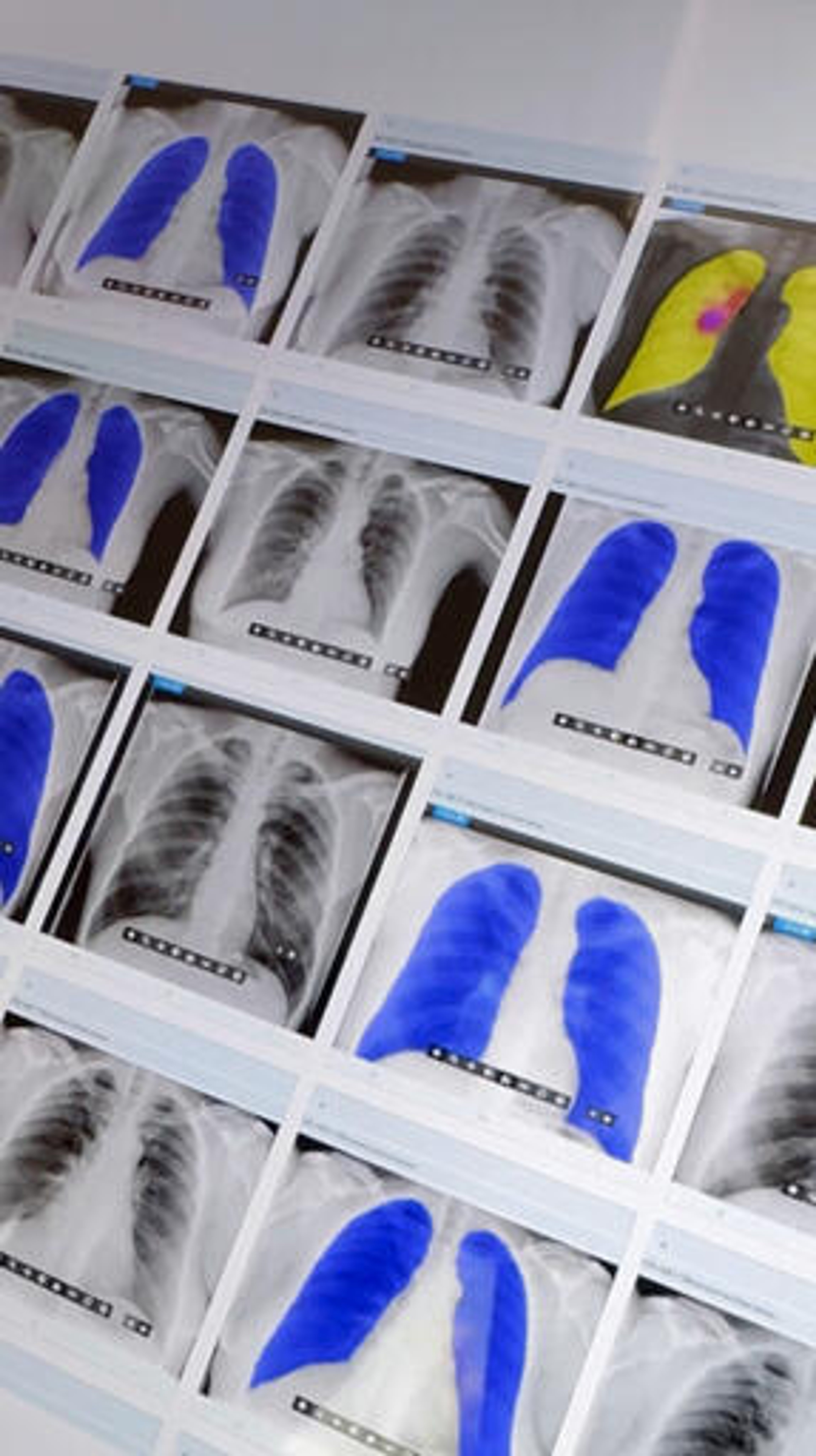 X-ray images from TB screening in Kulob district, southwestern Tajikistan.. The x-rays are black and white and blue and white and show the lungs.