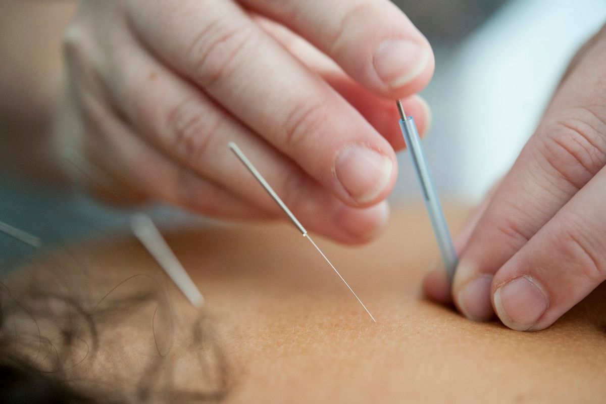 Aiguilles d'acupuncture implantées dans la peau d'un patient