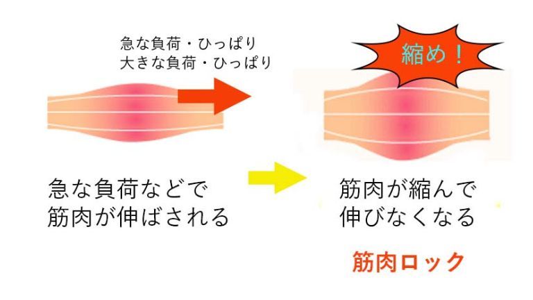 筋肉ロックとはからだの防衛反応