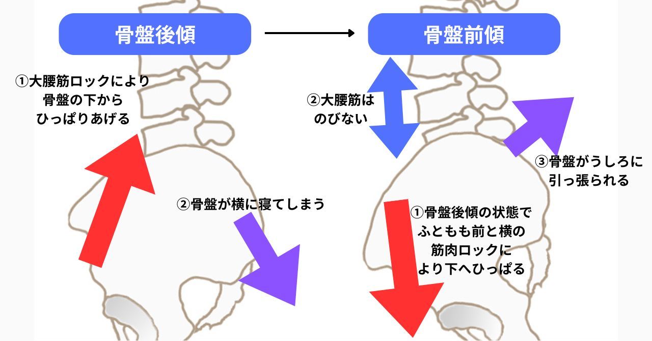 反り腰とは?