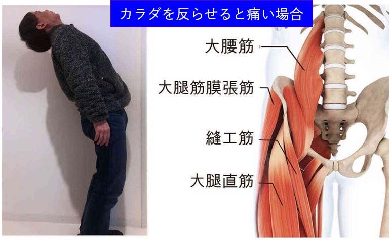 からだを反らせると痛む腰痛（伸展制限腰痛）