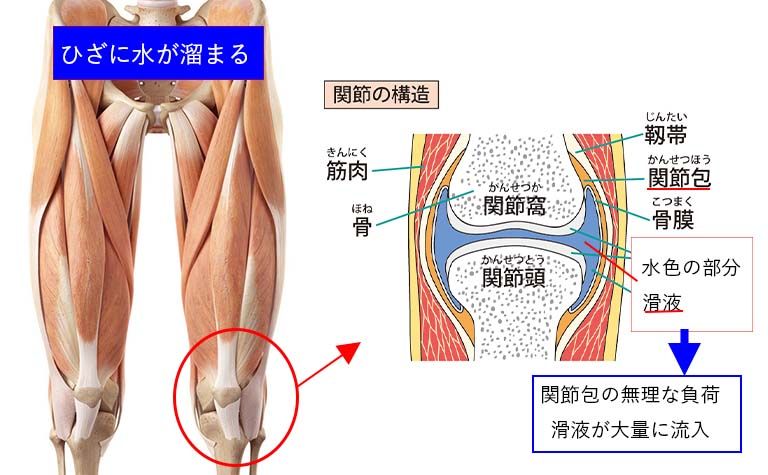 ひざに水が溜まるとは