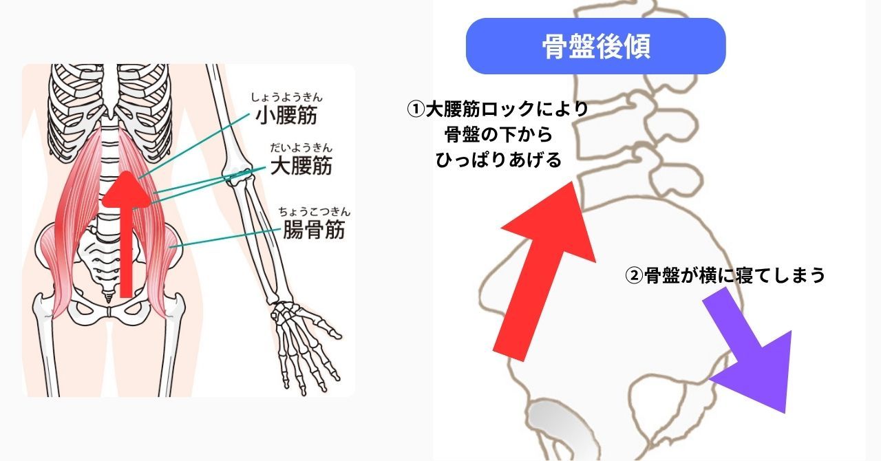 骨盤後傾とは?