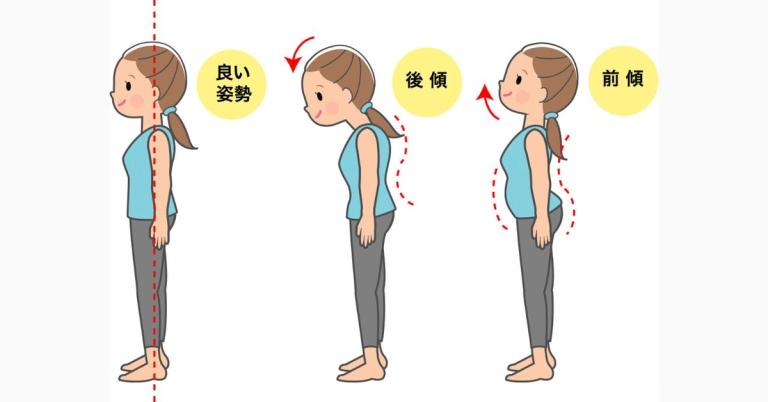 猫背や反り腰など骨盤のゆがみ