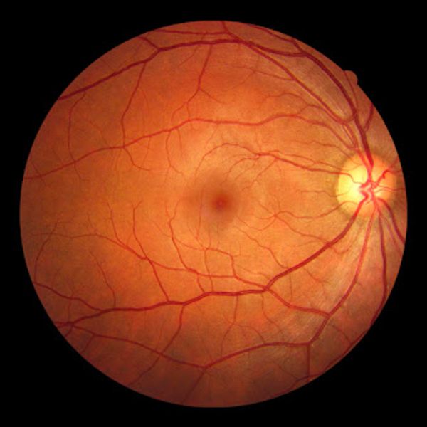 Retinal Examination — eye care service at Royal Opticals