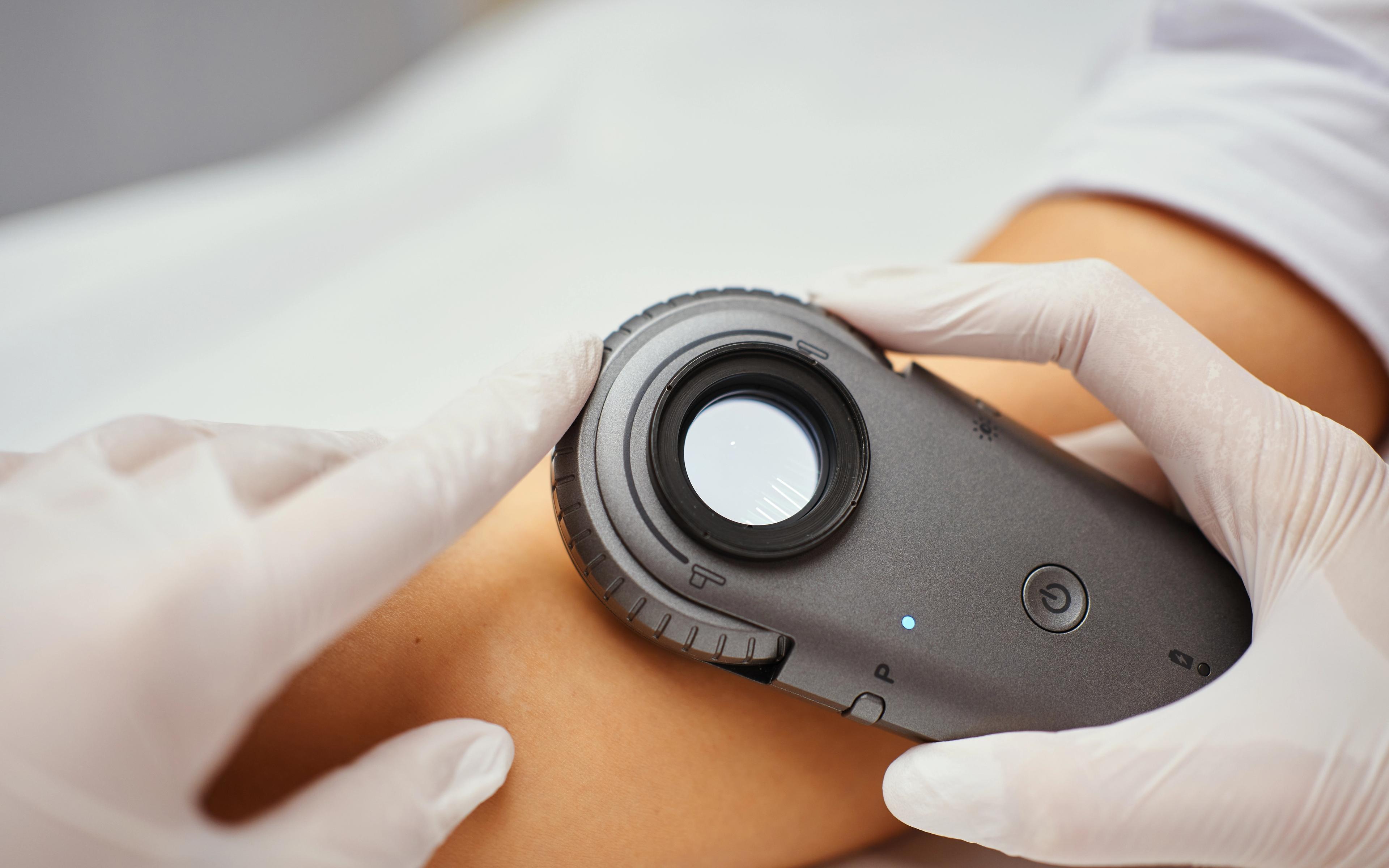 Dermatoscopul Video Avansat: Revoluționând Precizia și Eficiența în Cabinetul Dermatologic