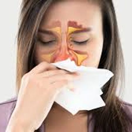 Acute Sinusitis