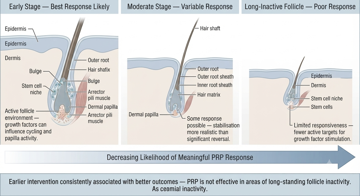Diagram showing follicle responsiveness to PRP across different stages of androgenetic alopecia