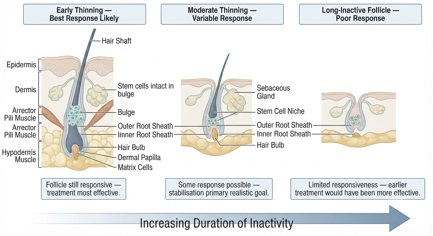 Diagram showing follicle responsiveness across different stages of androgenetic alopecia