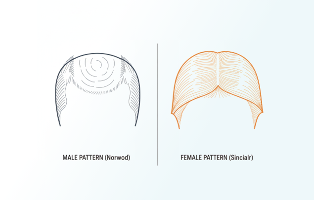 Male vs female pattern