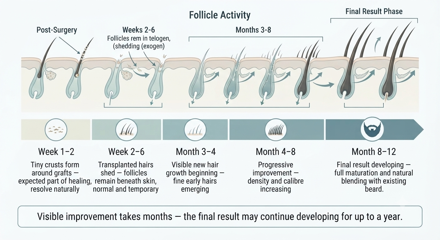 Post-operative timeline diagram for beard transplant recovery