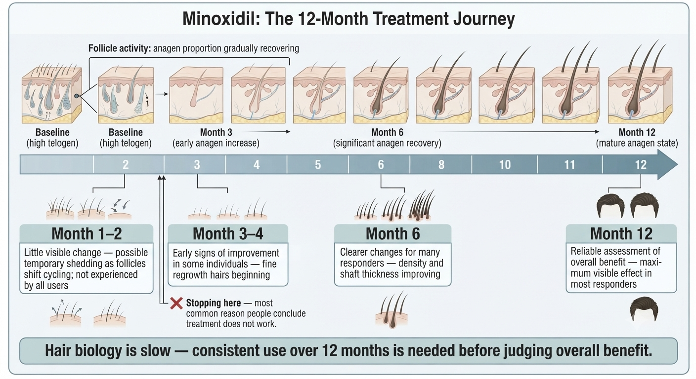 Month-by-month timeline of expected minoxidil treatment progression