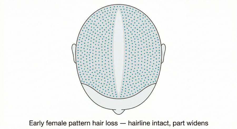 Diffuse thinning in early female pattern hair loss