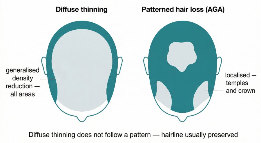 Diffuse hair thinning versus patterned hair loss