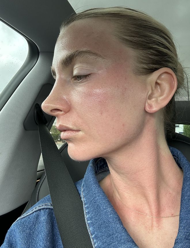 Clinic 1 BBL Moxi after