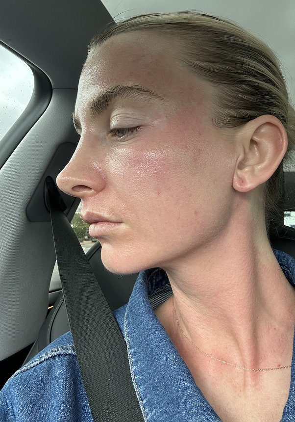 Clinic 1 BBL Moxi after