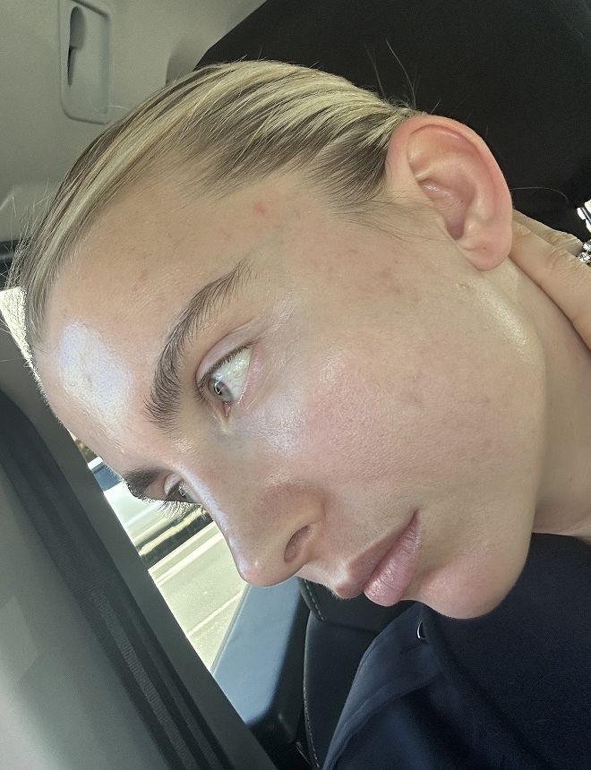 Clinic1 After BBL and Moxi