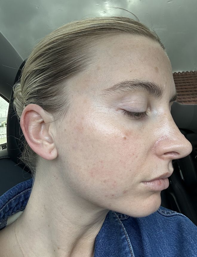 Clinic 1 BBL Moxi Before