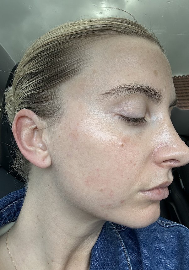 Clinic 1 BBL Moxi Before