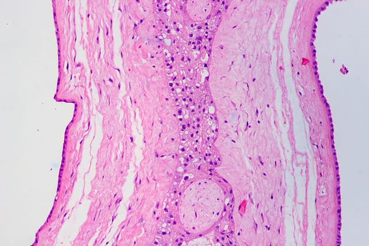 Diamniotic dischorionic placenta