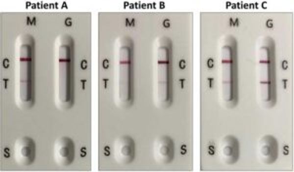 IgM and IgG antibody detection in three COVID-19 patients with a rapid antibody serology test.