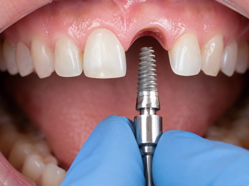Colocación de Implantes Dentales