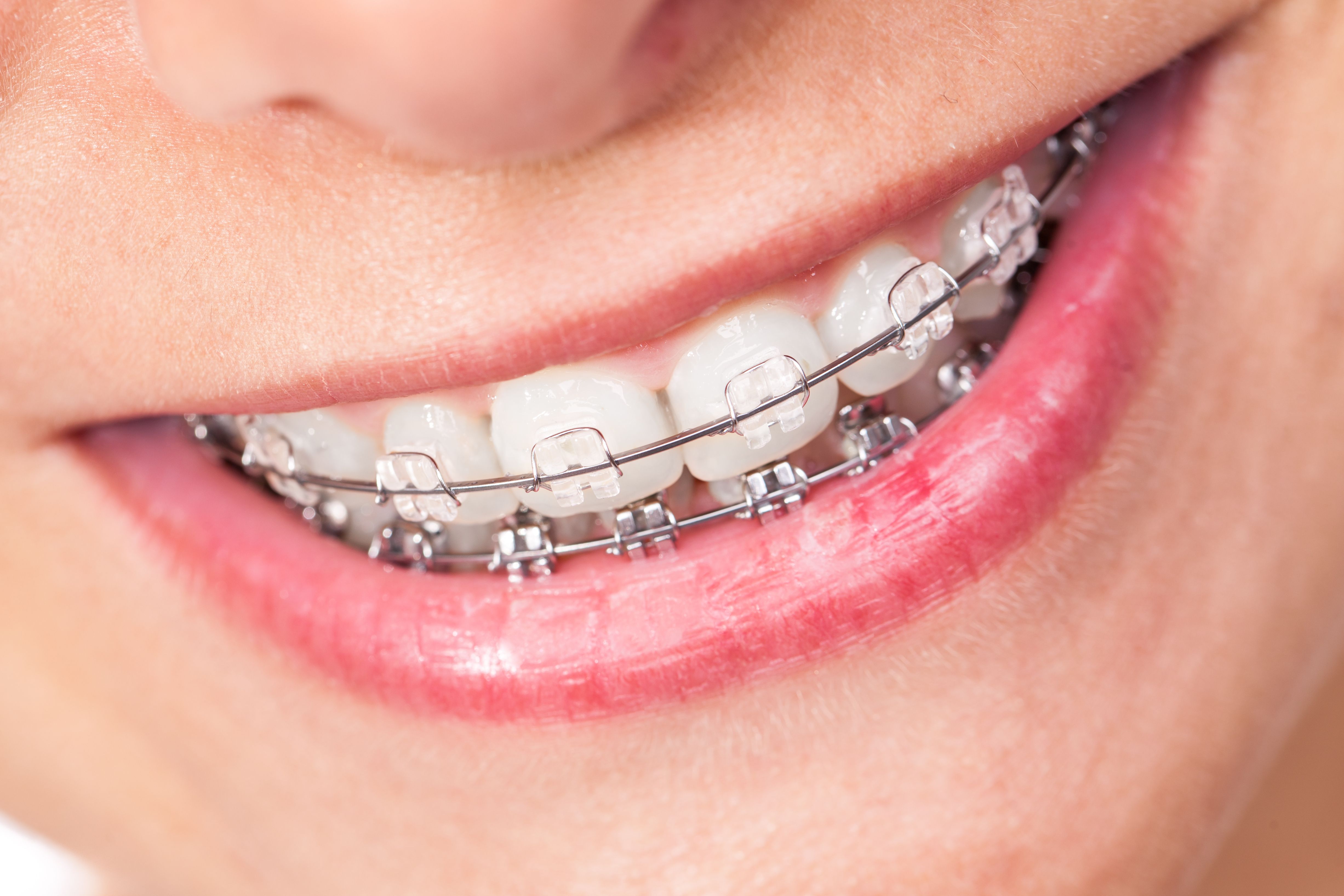 braces
