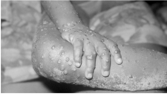 Mpox,