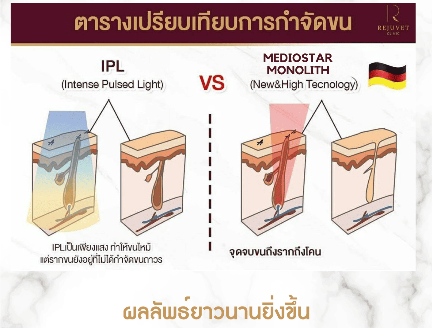 ขั้นตอนการกำจัดขน ผิวใส ด้วยเครื่อง Mediostar Monolith (Diod Laser)