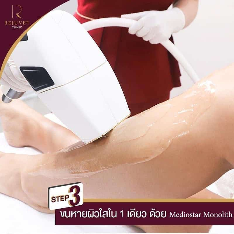 ขั้นตอนการกำจัดขน ผิวใส ด้วยเครื่อง Mediostar Monolith (Diod Laser)