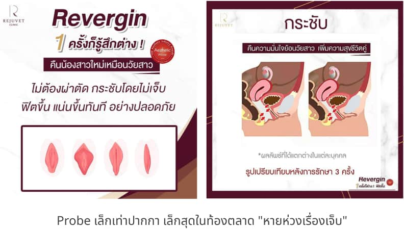 “VAGINAL REJUVENATION” คืออะไร