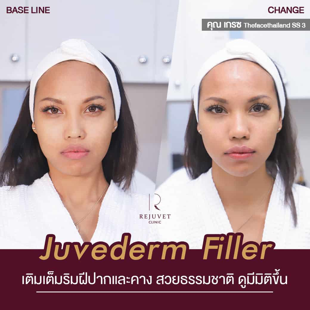 ขอขอบคุณ คุณ เกรซ Thefacethailand season 3 ที่ไว้วางใจให้ Rejuvet Clinic ได้ดูแลความเป๊ะนะคะ