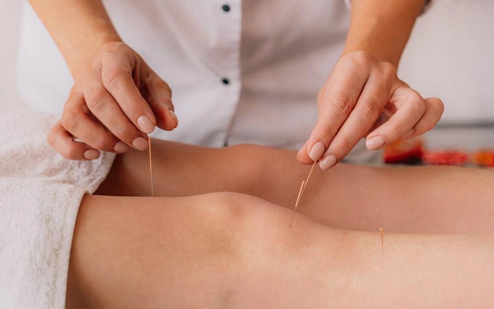 Acupuncture needles being placed in a patient's leg