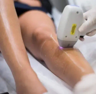 Experience the future of hair removal with Xlase Plus technology