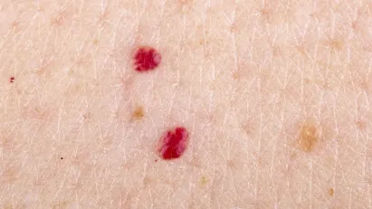 Cherry Angiomas: Removal & All You Need to Know