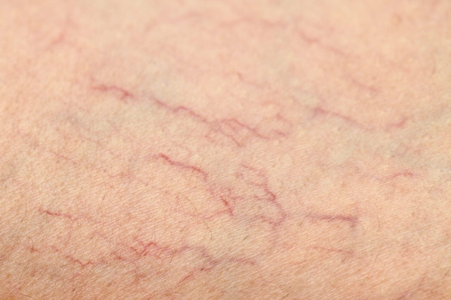 Spider Veins: Causes, Treatment and Prevention