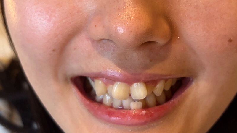 街角で声をかけて口内観察させてもらう カフェ店員 ひなちゃん ギャラリー 17