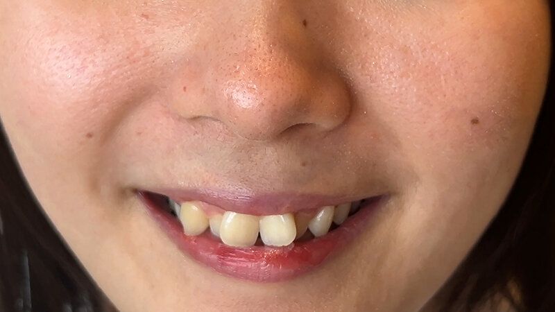 街角で声をかけて口内観察させてもらう カフェ店員 ひなちゃん ギャラリー 3