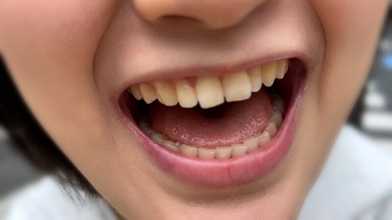 街角で声をかけて口内観察させてもらう 子供英語塾アルバイト のあちゃん ギャラリー 4