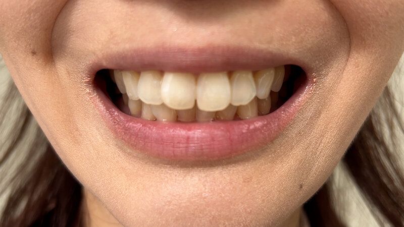 街角で声をかけて口内観察させてもらう スーパーのパート店員 まきさん ギャラリー 4