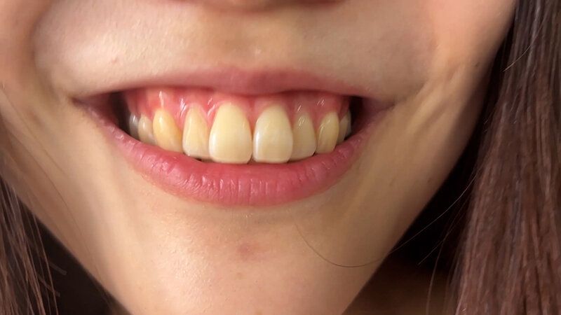 街角で声をかけて口内観察させてもらう アパレル店員 さゆりちゃん ギャラリー 8