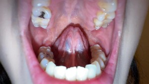 【個人撮影】横山夏希の舌ブラシで「汚舌苔」採取 ギャラリー 2