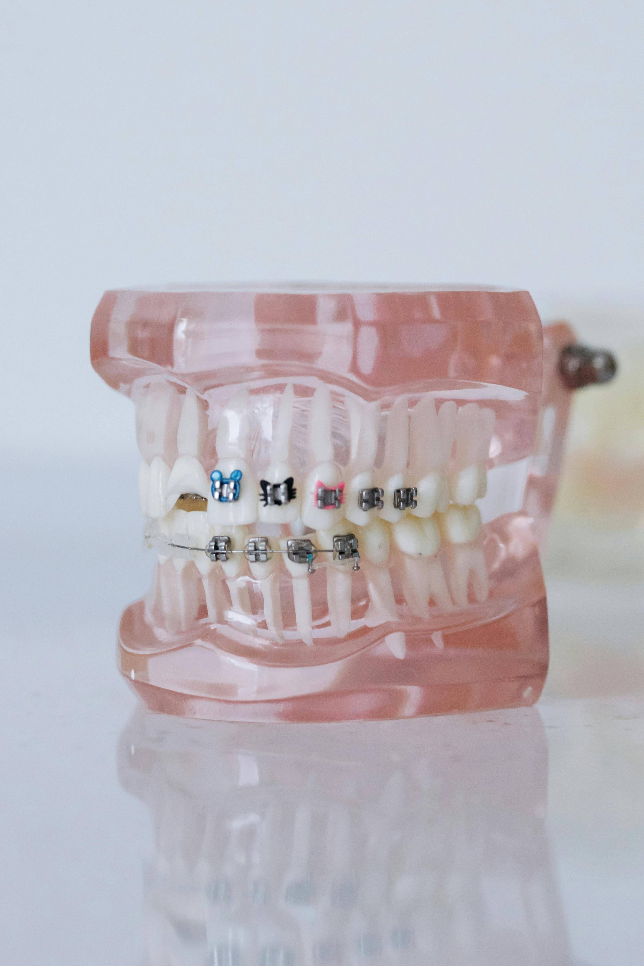 a full arch tooth model displaying fixed braces