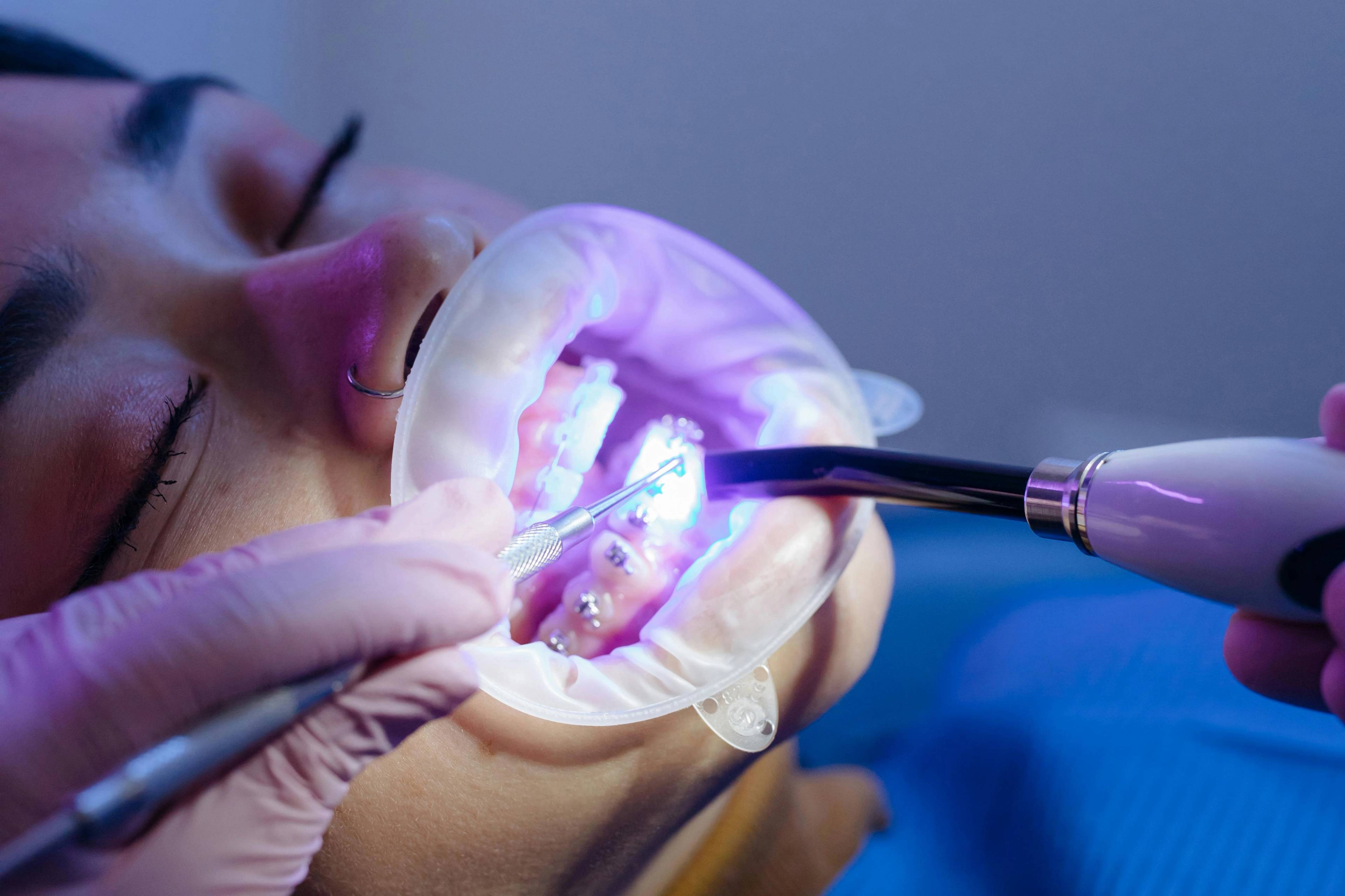 patient wearing fixed braces in dental surgery with an LED curing light