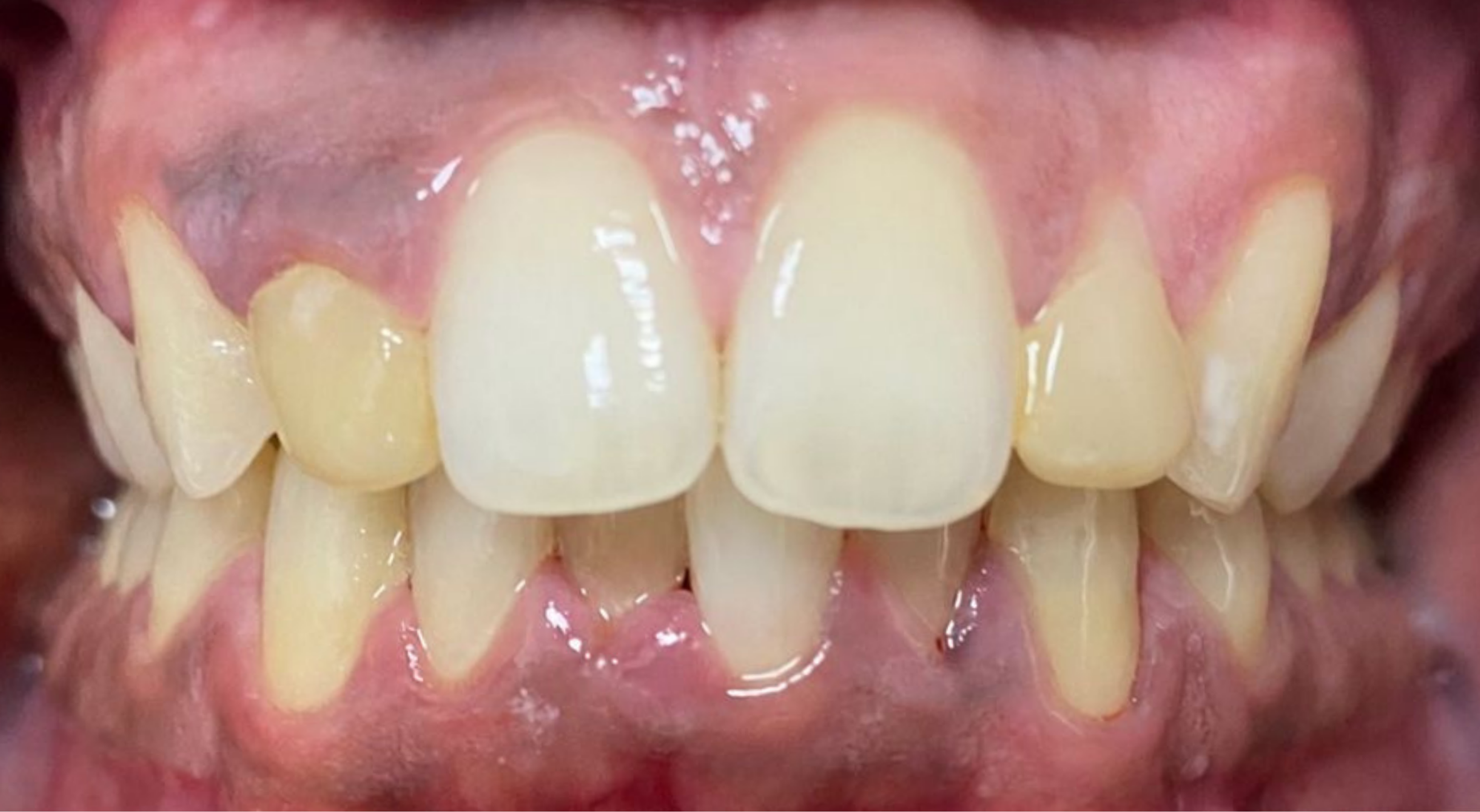 composite bonding case before